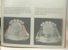 Conception et réalisation des prothèses partielles métalliques coulées sur modèle. Prof. Dr. R. Marxkors