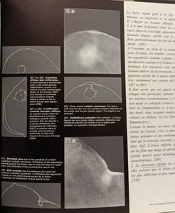 Les Images Mammographiques