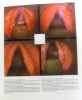 Larynx:Microlaryngoscopie et Histopathologie - Microlaryngoscopy and Histo. Pidoux  Widmann Lehmann