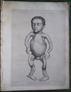 Du Rachitis, de la fragilité des os, de l'ostéomalacie.