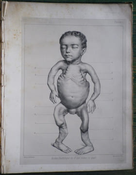 Du Rachitis, de la fragilité des os, de l'ostéomalacie.. [Médecine - Rachitisme] - BEYLARD (E. J.) (de Philadelphie).