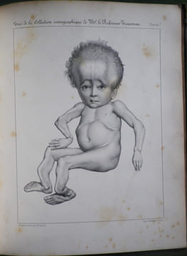 Du Rachitis, de la fragilité des os, de l'ostéomalacie.. [Médecine - Rachitisme] - BEYLARD (E. J.) (de Philadelphie).