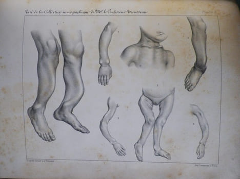 Du Rachitis, de la fragilité des os, de l'ostéomalacie.. [Médecine - Rachitisme] - BEYLARD (E. J.) (de Philadelphie).