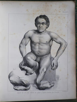 Du Rachitis, de la fragilité des os, de l'ostéomalacie.. [Médecine - Rachitisme] - BEYLARD (E. J.) (de Philadelphie).