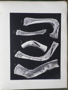 Du Rachitis, de la fragilité des os, de l'ostéomalacie.. [Médecine - Rachitisme] - BEYLARD (E. J.) (de Philadelphie).