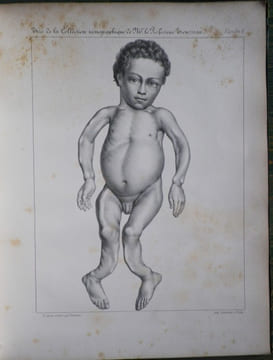Du Rachitis, de la fragilité des os, de l'ostéomalacie.. [Médecine - Rachitisme] - BEYLARD (E. J.) (de Philadelphie).