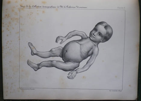 Du Rachitis, de la fragilité des os, de l'ostéomalacie.. [Médecine - Rachitisme] - BEYLARD (E. J.) (de Philadelphie).