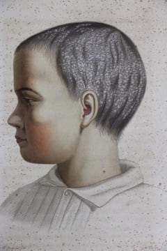 Traité des maladies du cuir chevelu suivi de conseils hygiéniques sur les coins à donner à la chevelure. CAZENAVE Alphée