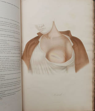 Leçons sur les maladies de la peau. CAZENAVE, P.-L. Alphée