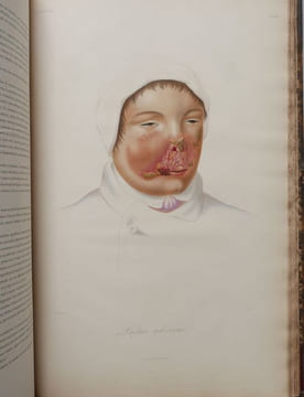 Leçons sur les maladies de la peau. CAZENAVE, P.-L. Alphée