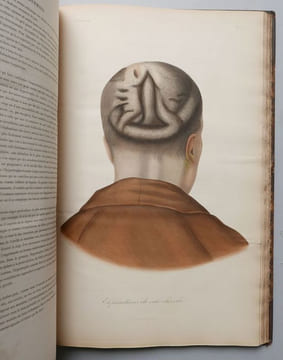 Leçons sur les maladies de la peau. CAZENAVE, P.-L. Alphée