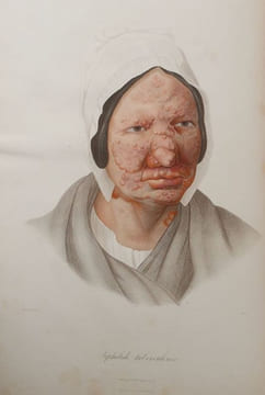 Leçons sur les maladies de la peau. CAZENAVE, P.-L. Alphée