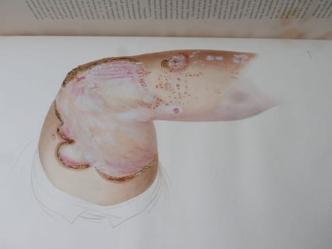 Leçons sur les maladies de la peau. CAZENAVE, P.-L. Alphée