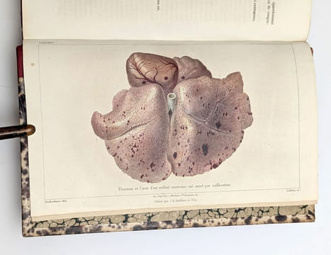 Étude médico-légale sur l'avortement... [Suivi de ] Étude médico-légale sur la pendaison, la strangulation et la suffocation. TARDIEU, Ambroise