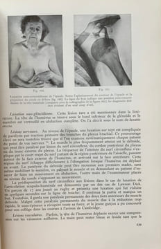 Fractures et lésions articulaires traumatiques (2 volumes). . Watson-Jones, Reginald (Sir)
