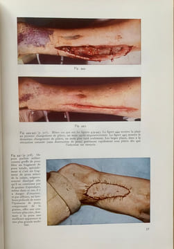 Fractures et lésions articulaires traumatiques (2 volumes). . Watson-Jones, Reginald (Sir)