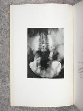 LA PHLEBOGRAPHIE PELVIENNE.. BAUX RENE (DOCTEUR).