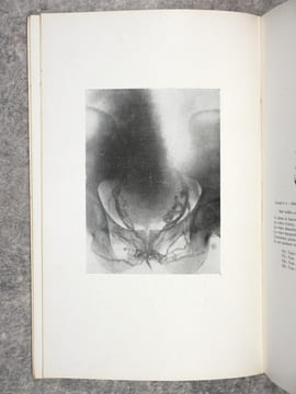 LA PHLEBOGRAPHIE PELVIENNE.. BAUX RENE (DOCTEUR).