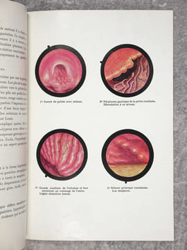 GASTROSCOPIE AVEC APPAREILS FLEXIBLES, PAR J. BAUMEL, PROFESSEUR AGREGE A LA FACULTE DE MEDECINE DE MONTPELLIER. (BRONCHOSCOPIE. OESOPHAGOSCOPIE. ...