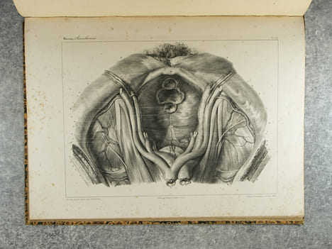 TRAITE PRATIQUE DES ACCOUCHEMENTS PAR F. J. MOREAU. ATLAS DE PLANCHES EXECUTEES D’APRES NATURE PAR EMILE BEAU, SUR LES PREPARATIONS ANATOMIQUES DE M. ...