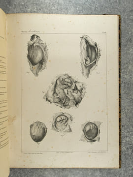 TRAITE PRATIQUE DES ACCOUCHEMENTS PAR F. J. MOREAU. ATLAS DE PLANCHES EXECUTEES D’APRES NATURE PAR EMILE BEAU, SUR LES PREPARATIONS ANATOMIQUES DE M. ...