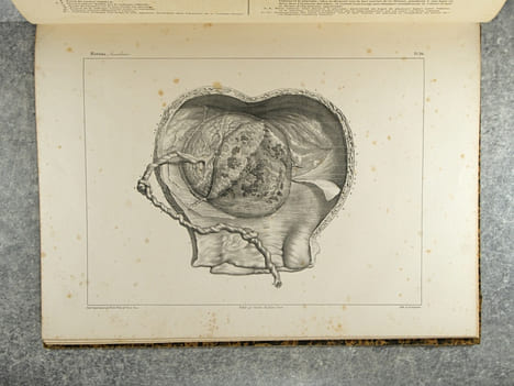 TRAITE PRATIQUE DES ACCOUCHEMENTS PAR F. J. MOREAU. ATLAS DE PLANCHES EXECUTEES D’APRES NATURE PAR EMILE BEAU, SUR LES PREPARATIONS ANATOMIQUES DE M. ...