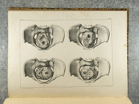 TRAITE PRATIQUE DES ACCOUCHEMENTS PAR F. J. MOREAU. ATLAS DE PLANCHES EXECUTEES D’APRES NATURE PAR EMILE BEAU, SUR LES PREPARATIONS ANATOMIQUES DE M. ...