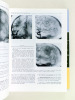 Traité de Radiodiagnostic. Tome XIV : Neuroradiologie. Partie 2 : Crâne, Encéphale, Paires craniennes. Volume deuxième : Pathologie tumorale. La ...