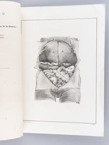 Quelques considérations sur le cancer mélanique du Foie. Thèse présentée à la Faculté de Médecine de Strasbourg, soutenue le 28 décembre 1866 [ Edition originale - Livre dédicacé par l'auteur ]