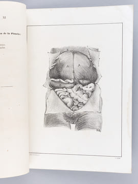 Quelques considérations sur le cancer mélanique du Foie. Thèse présentée à la Faculté de Médecine de Strasbourg, soutenue le 28 décembre 1866 [ ...