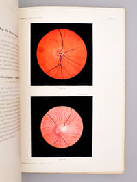Diagnostic Ophtalmoscopique d'après des reproductions types de Fonds d'Yeux, avec examen spécial des cas importants de médecine générale pour les médecins et les étudiants (2 tomes, complet)