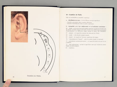 Traité d'acupuncture auriculaire. . GROBGLAS, André , LEVY, Jacques