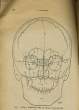 NOTES PRATIQUES SUR L'EXPLORATION RADIOLOGIQUE DES TRAUMATISMES CRANIENS - N°5. A. PELLEGRINO