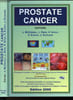 POSTATE CANCER. COLLECTIF