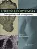 Uterine Leiomyomata Pathogenesis and Management.. Brosens Ivo