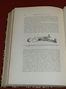 Traité de Médecine Opératoire et de Thérapeutique Chirurgicale : Chirurgie Orthopédique par le Professeur Paul Berger et le Docteur S. Banzet. 