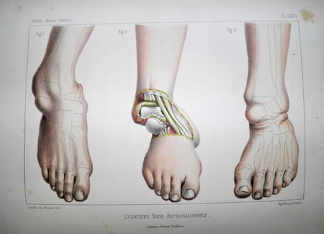 Traité iconographique des maladies chirurgicales. Précédé d'une introduction par M. Velpeau. Dessins d'après nature par MM. Bion, Léveillé et Beau. . ...