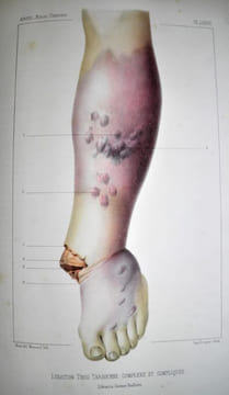 Traité iconographique des maladies chirurgicales. Précédé d'une introduction par M. Velpeau. Dessins d'après nature par MM. Bion, Léveillé et Beau. . ...