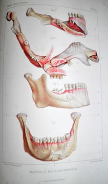 Traité iconographique des maladies chirurgicales. Précédé d'une introduction par M. Velpeau. Dessins d'après nature par MM. Bion, Léveillé et Beau. . ...