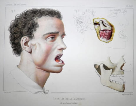 Traité iconographique des maladies chirurgicales. Précédé d'une introduction par M. Velpeau. Dessins d'après nature par MM. Bion, Léveillé et Beau. . ...