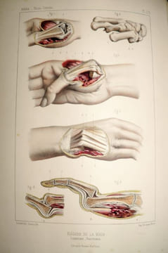Traité iconographique des maladies chirurgicales. Précédé d'une introduction par M. Velpeau. Dessins d'après nature par MM. Bion, Léveillé et Beau. . ...