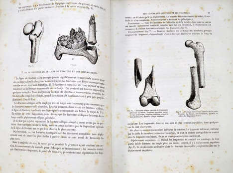 Traité iconographique des maladies chirurgicales. Précédé d'une introduction par M. Velpeau. Dessins d'après nature par MM. Bion, Léveillé et Beau. . ...