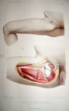 Traité iconographique des maladies chirurgicales. Précédé d'une introduction par M. Velpeau. Dessins d'après nature par MM. Bion, Léveillé et Beau. . ...