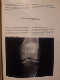 Les grands syndromes inflammatoires.T1: Polyarthrite rhumatoïdeT2: Spondylarthrite ankylosanteT3: Arthropathies microstallines