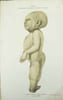 Mus&eacute;e d'anatomie de la Facult&eacute; de m&eacute;decine de Strasbourg. Description de deux foetus monstres, dont l'un ac&eacute;phale et l'autre monopode.. EHRMANN, ...
