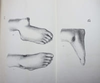 Etude sur les résections anaplastiques articulaires.