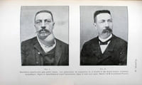 Thérapeutique chirurgicale du goitre. Anatomie chirurgicale normale et pathologique. Thyroïdectomie partielle, énucléations exothyropexie.