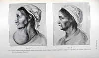Thérapeutique chirurgicale du goitre. Anatomie chirurgicale normale et pathologique. Thyroïdectomie partielle, énucléations exothyropexie.