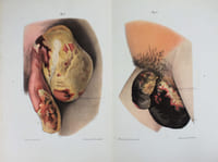 Contribution à l'étude des gangrènes dites foudroyantes spontanées des organes génitaux externe de l'homme.