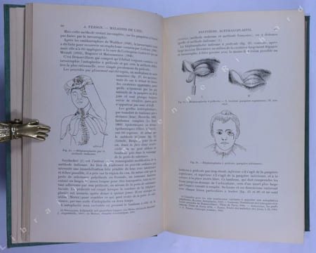 Nouveau traité de chirurgie. XVII Maladies de l'oeil.. TERSON Albert